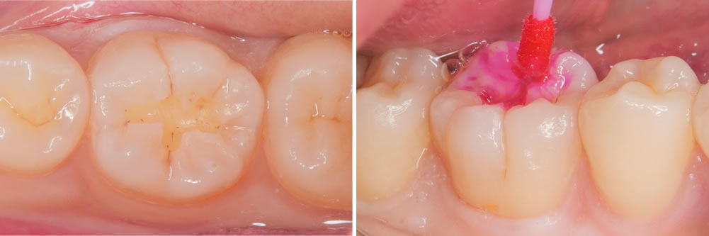 虫歯治療の除去