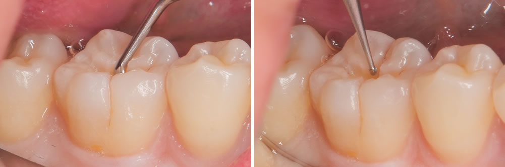虫歯治療の除去