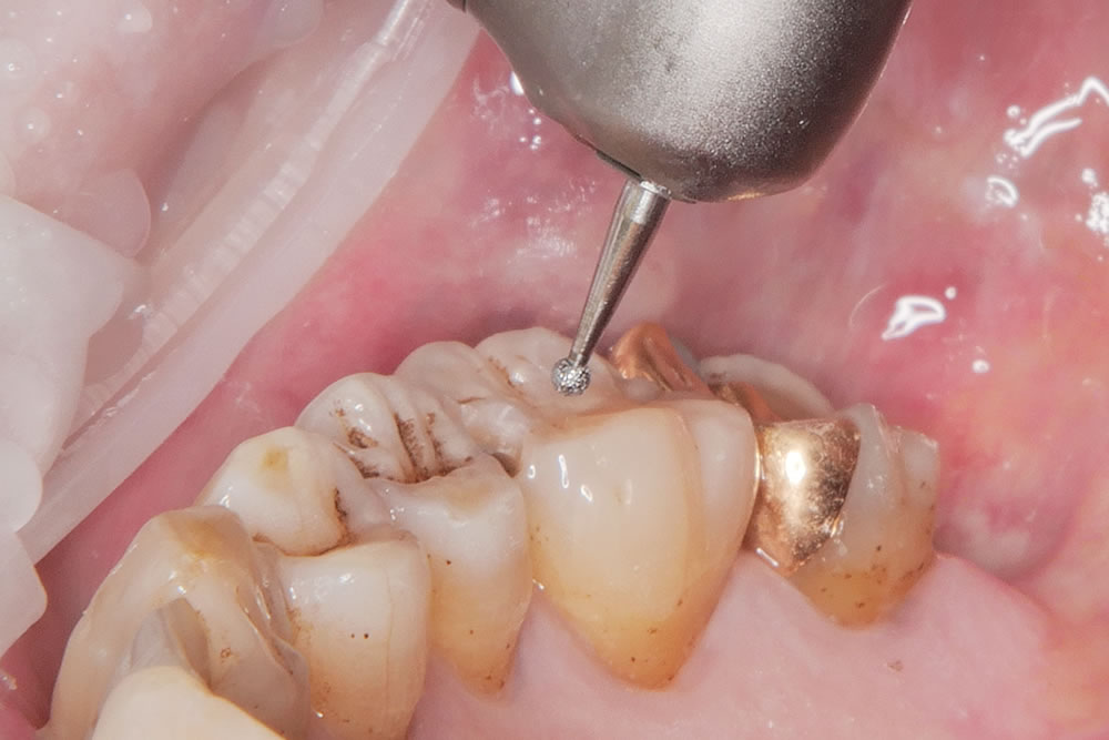 虫歯治療の実施