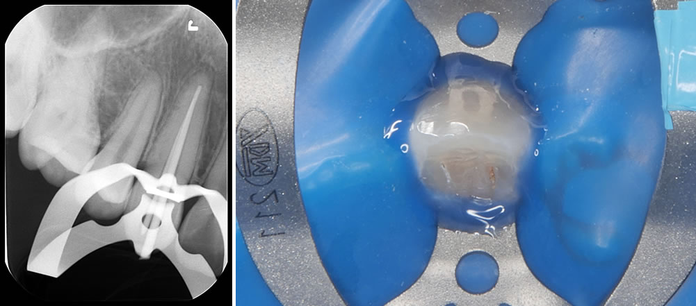 精密根管治療の実施