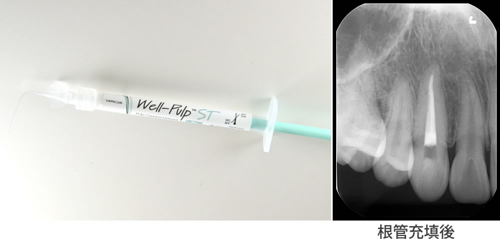 精密根管治療の実施