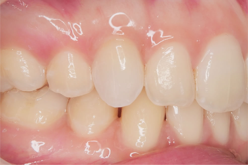 インターナルブリーチの実施