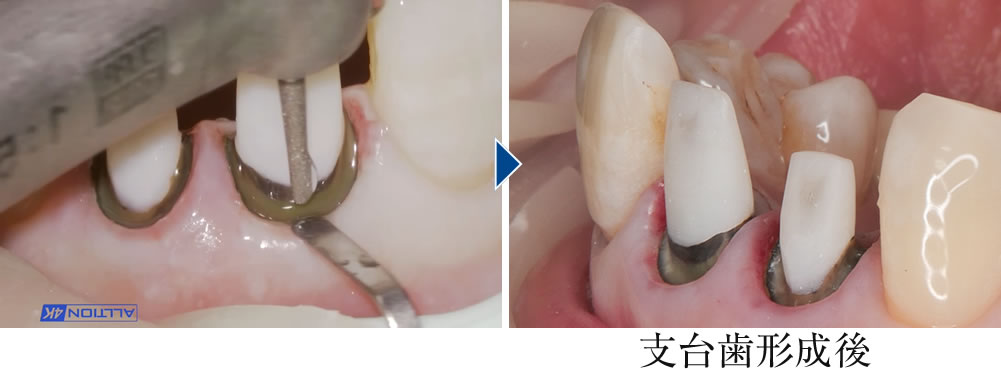 支台形成