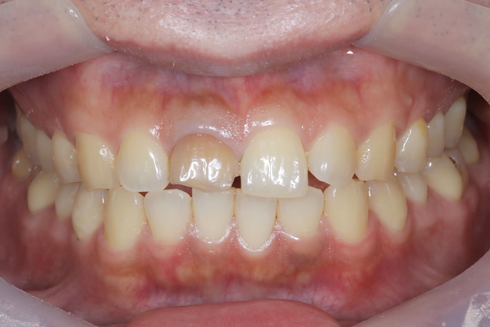 初診時の口腔内