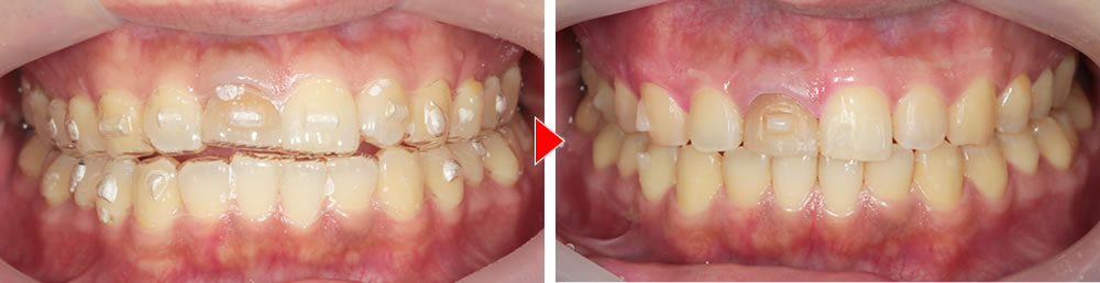 マウスピース矯正（インビザライン）による歯並びの改善