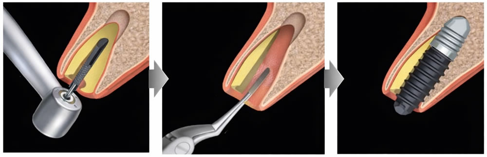 ソケットシールドテクニック