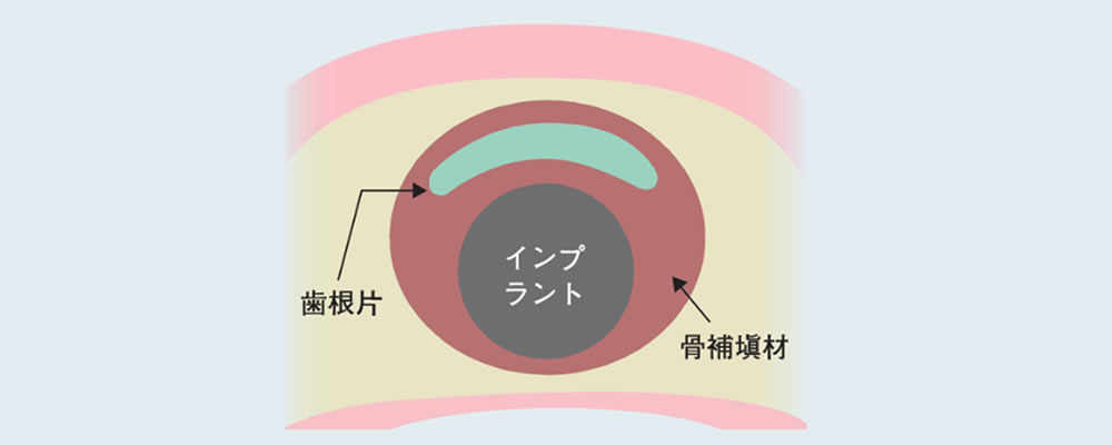 ソケットシールドテクニック