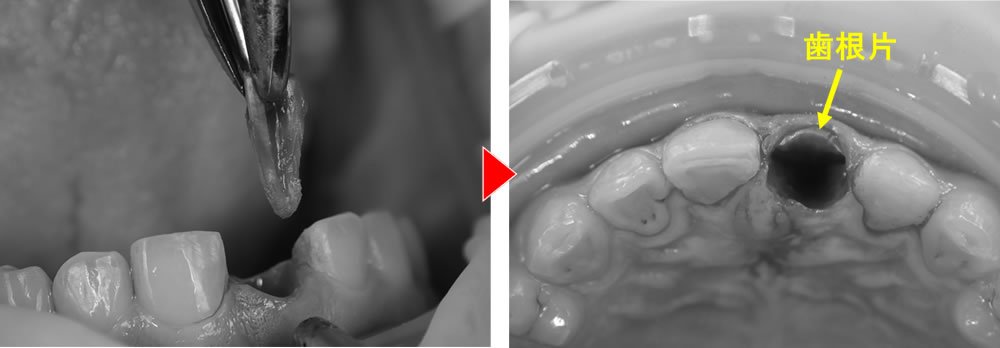 当該歯を部分的に抜歯