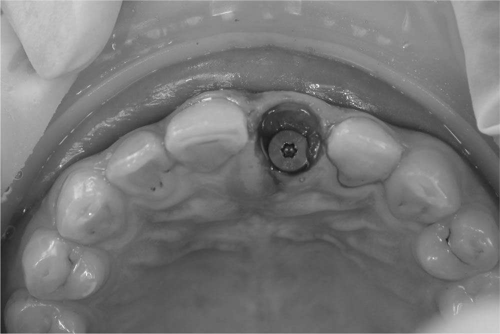 インプラントの埋入
