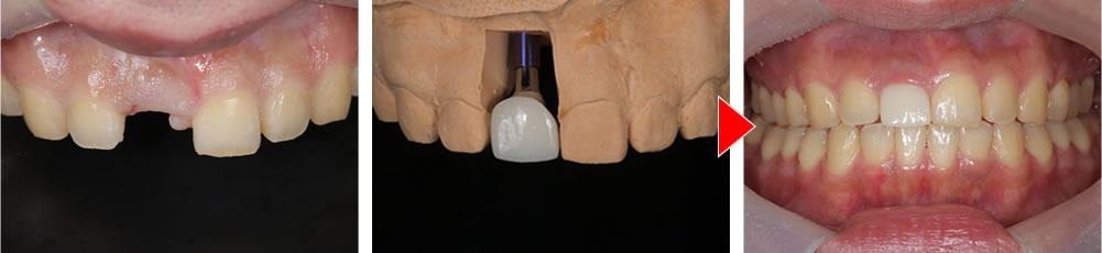 プロビジョナルレストレーション（精密な仮歯）を作成・装着