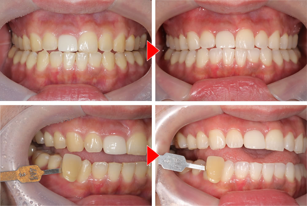 ホワイトニングの実施