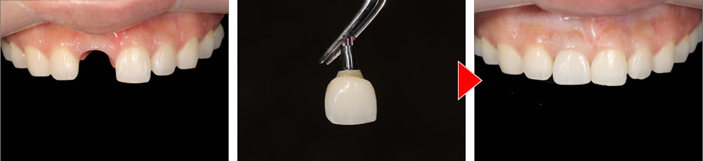 最終のインプラントの上部構造（ジルコニア）を装着