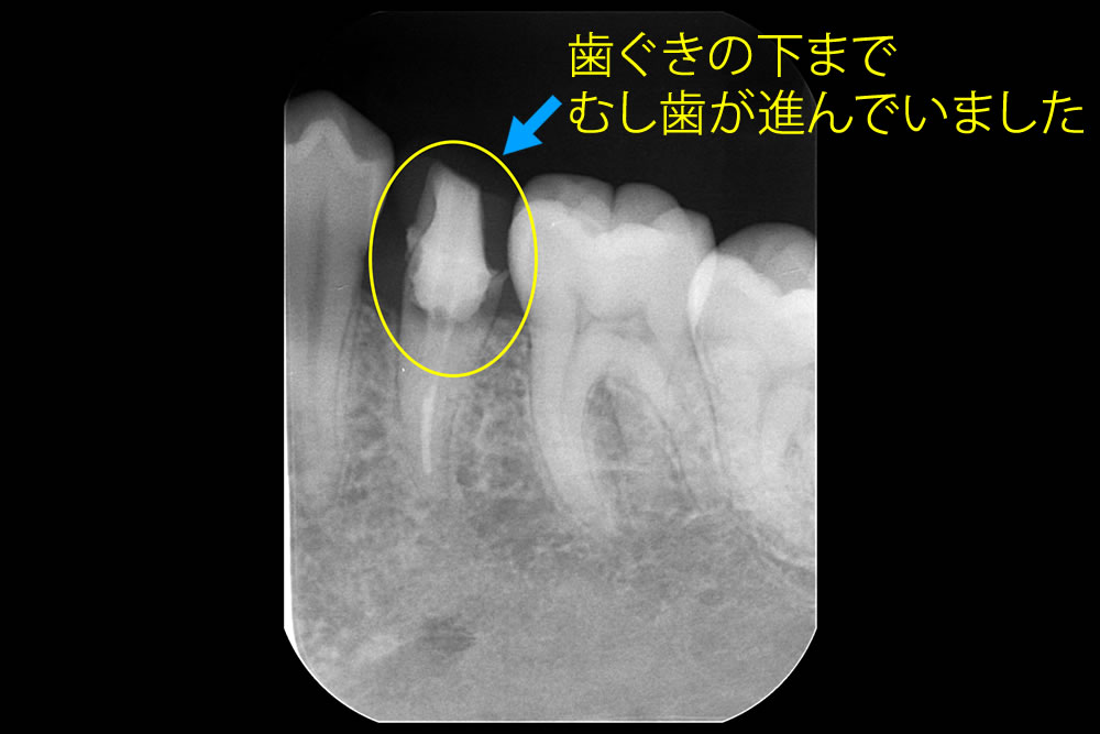 初診時の状態