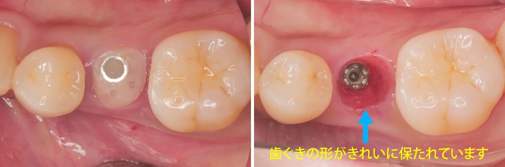 インプラント手術から3ヵ月後