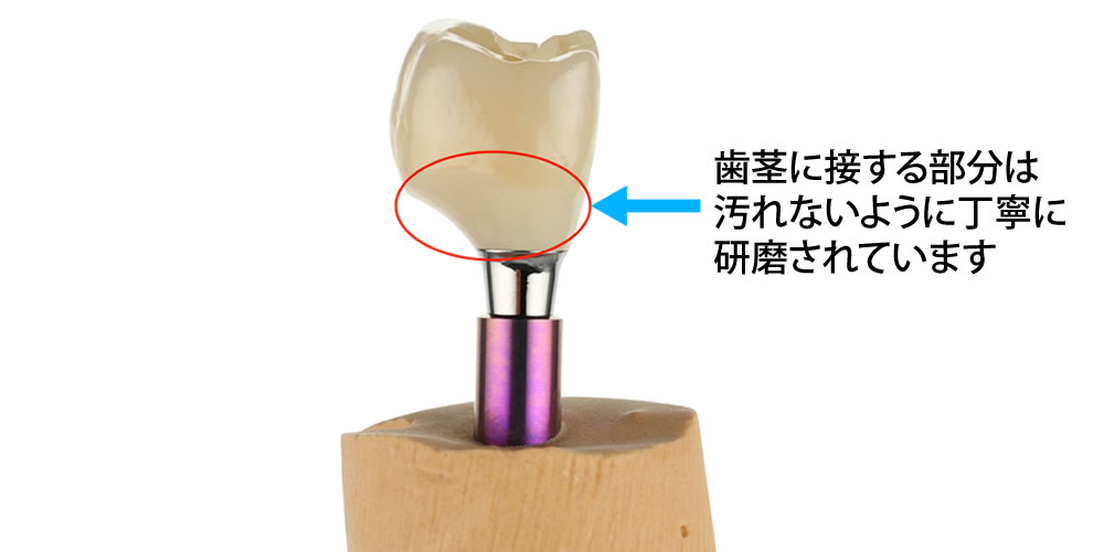 かぶせ物の製作