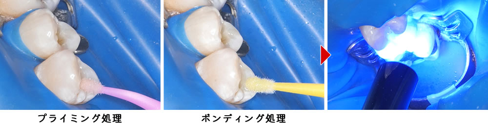 ダイレクトボンディングの前処理