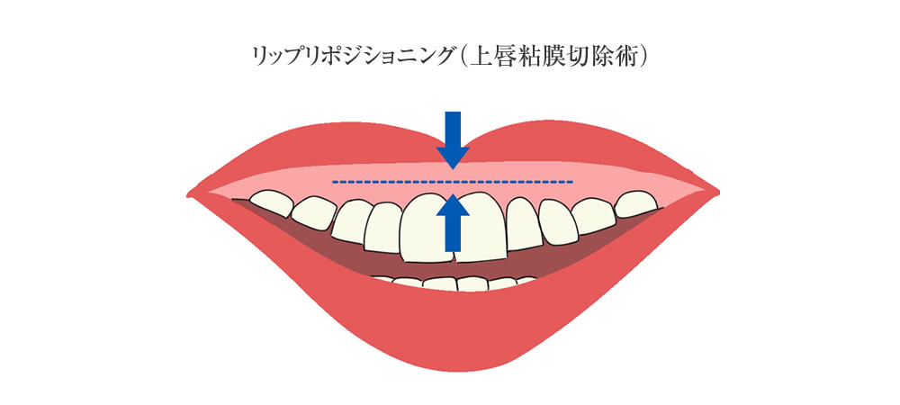リップリポジショニング（上唇粘膜切除術）
