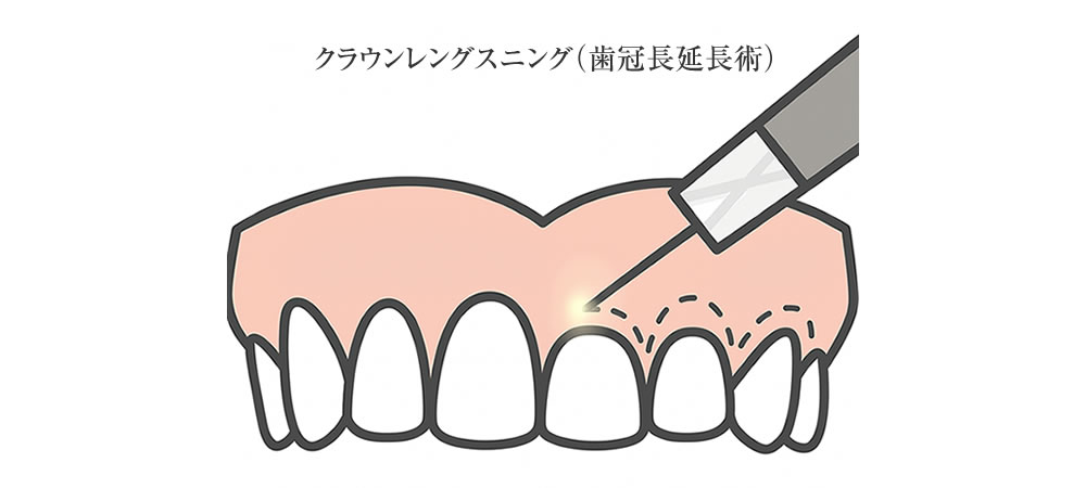 歯冠長延長術（クラウンレングスニング）