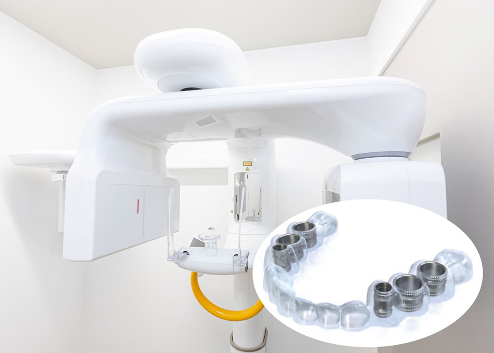 CTによる精密検査とサージカルガイドを活用したインプラント治療