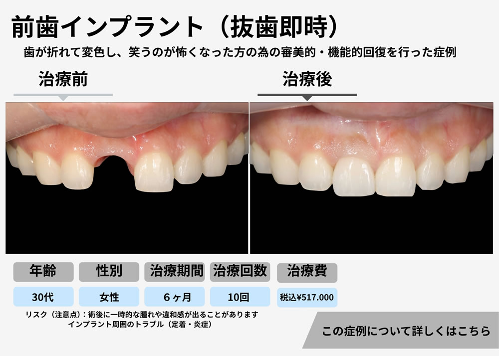 前歯インプラント